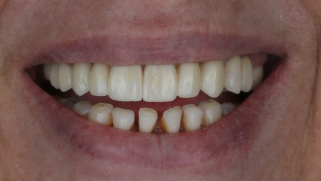 Réhabilitation complète uni maxillaire