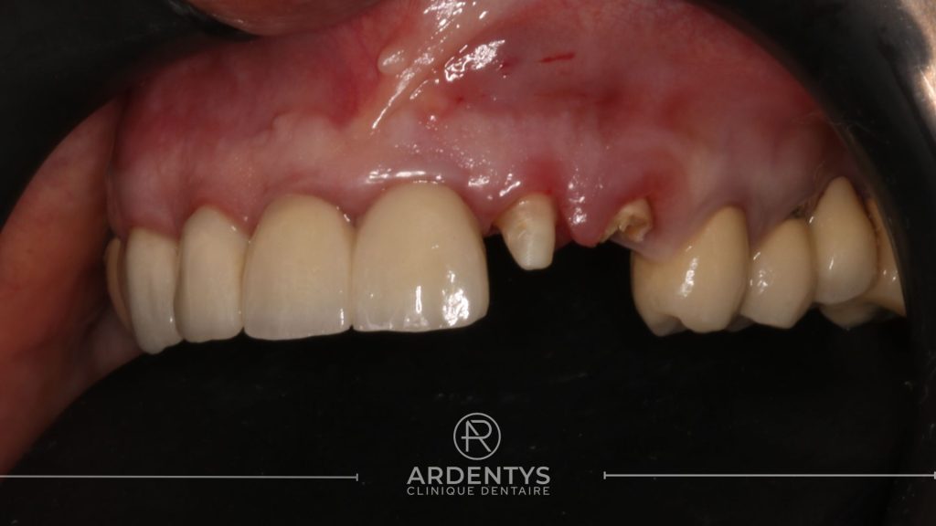 Réhabilitation partielle