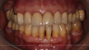 Réhabilitation partielle