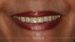 Réhabilitation partielle