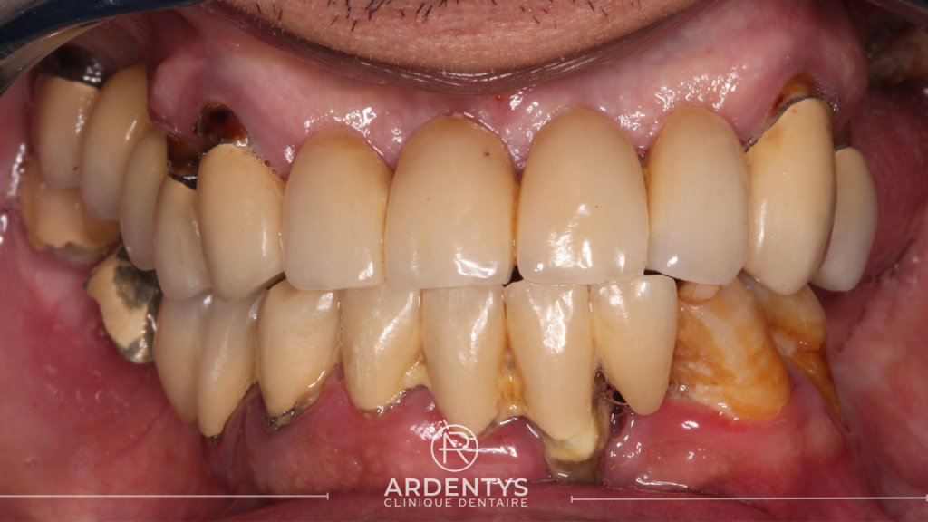 Réhabilitation complète bi maxillaire