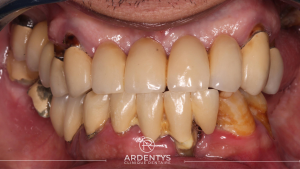 Réhabilitation complète bi maxillaire