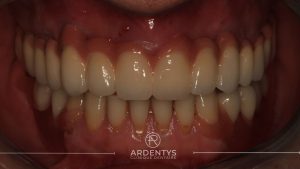 Réhabilitation complète uni maxillaire