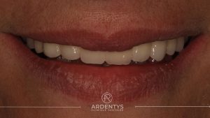 Réhabilitation complète uni maxillaire