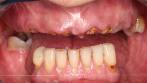 Réhabilitation complète uni maxillaire