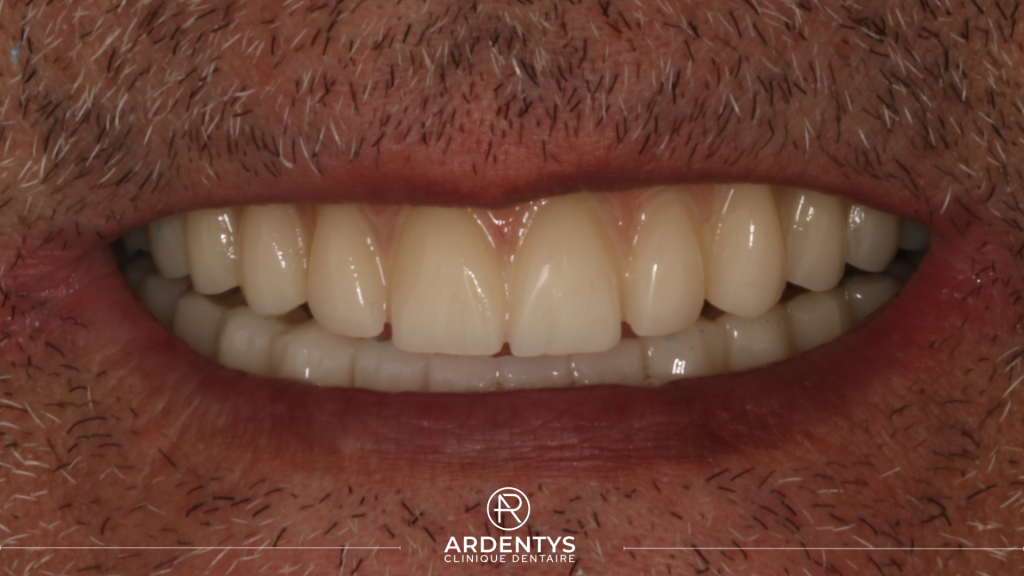 Réhabilitation complète bi maxillaire