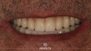 Réhabilitation complète bi maxillaire