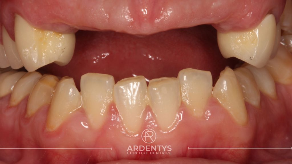 Réhabilitation partielle