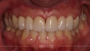 Réhabilitation partielle