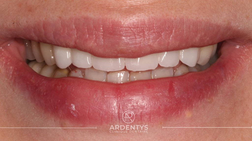 Réhabilitation partielle