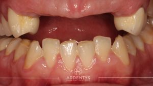 Réhabilitation partielle