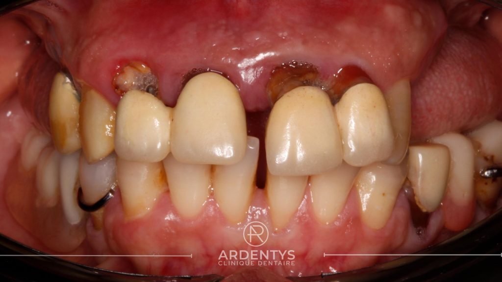 Réhabilitation complète uni maxillaire