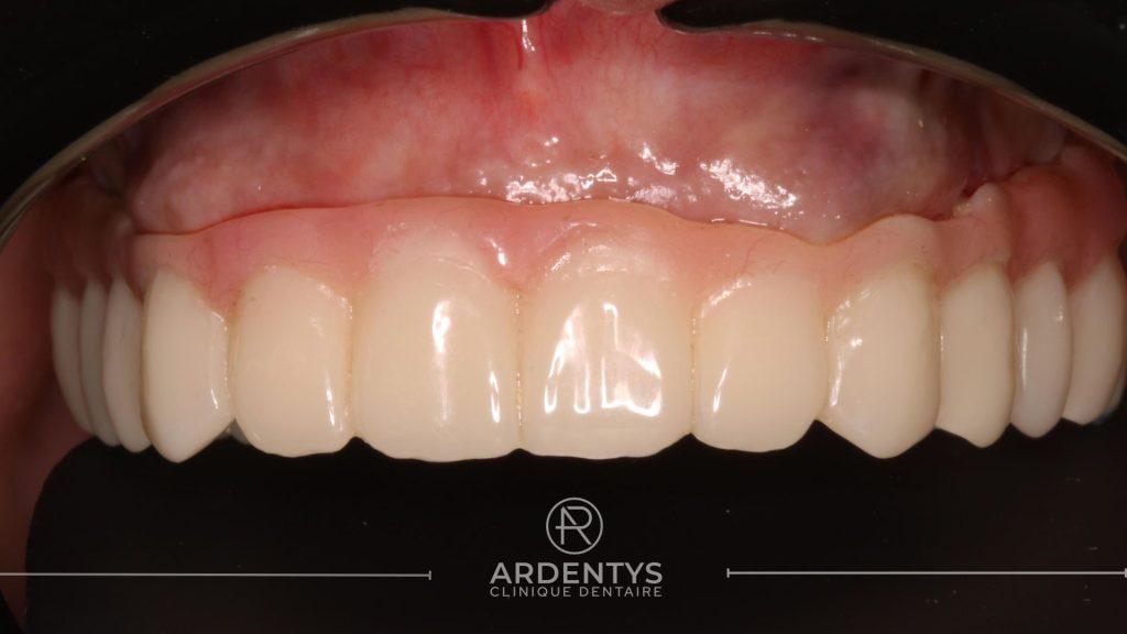 Réhabilitation complète uni maxillaire