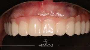 Réhabilitation complète uni maxillaire