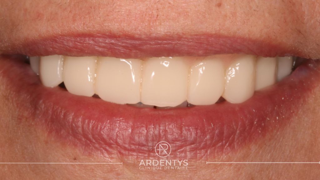 Réhabilitation complète uni maxillaire