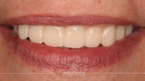 Réhabilitation complète uni maxillaire