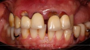 Réhabilitation complète uni maxillaire