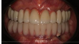 Réhabilitation complète uni maxillaire