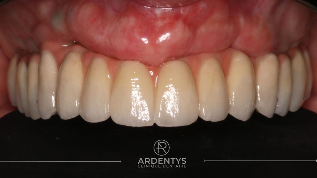 Réhabilitation complète uni maxillaire