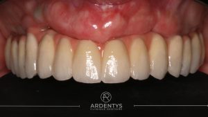 Réhabilitation complète uni maxillaire