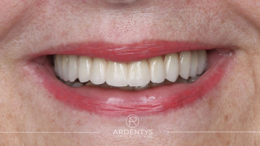 Réhabilitation complète uni maxillaire