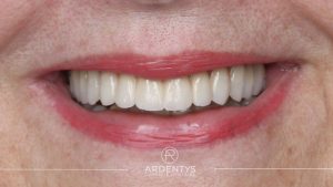 Réhabilitation complète uni maxillaire