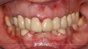 Réhabilitation complète uni maxillaire