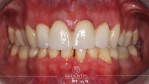 Réhabilitation partielle