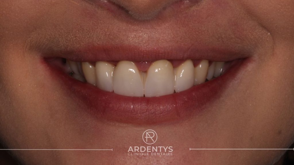 Réhabilitation partielle