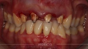 Réhabilitation partielle