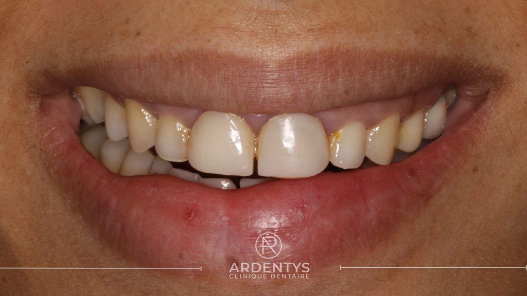 Réhabilitation partielle