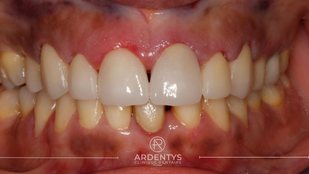 Réhabilitation partielle