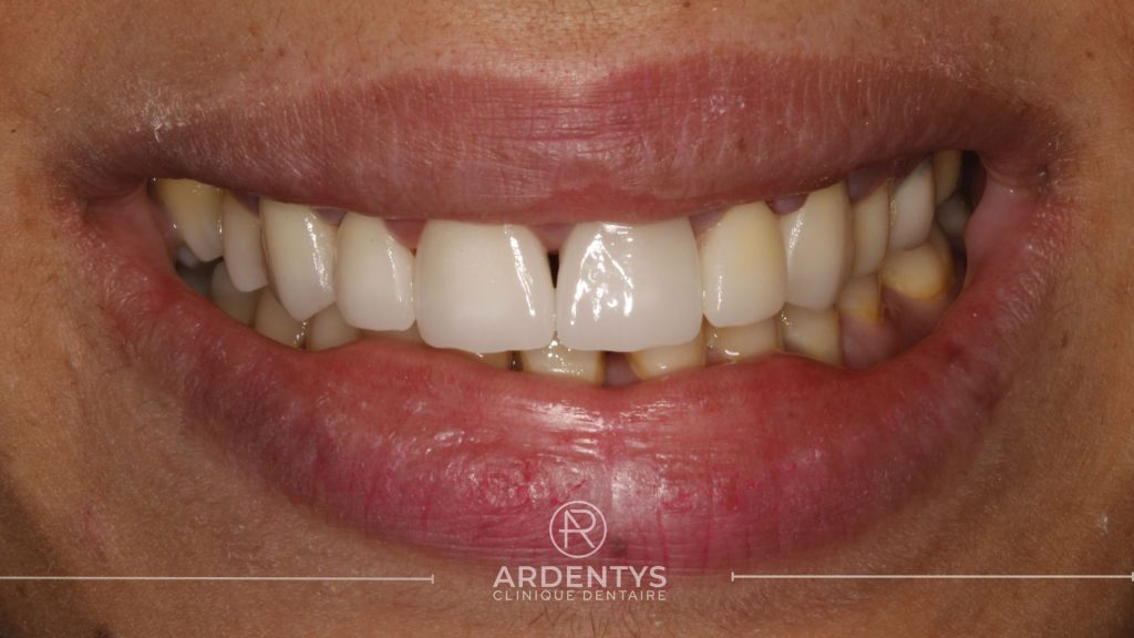 Réhabilitation partielle