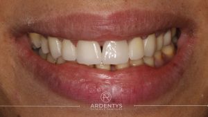 Réhabilitation partielle