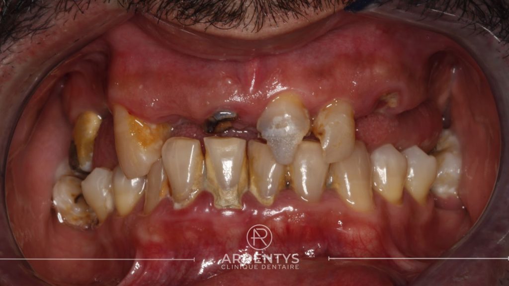 Réhabilitation complète uni maxillaire