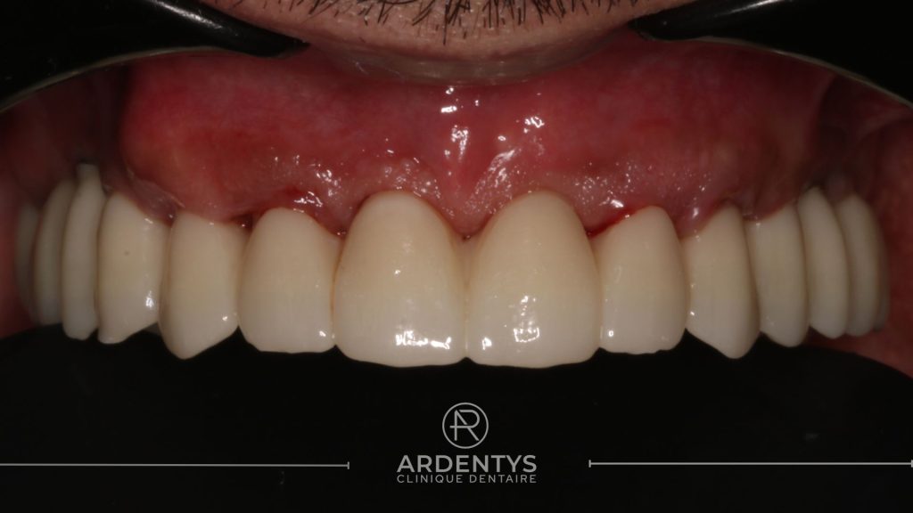 Réhabilitation complète uni maxillaire