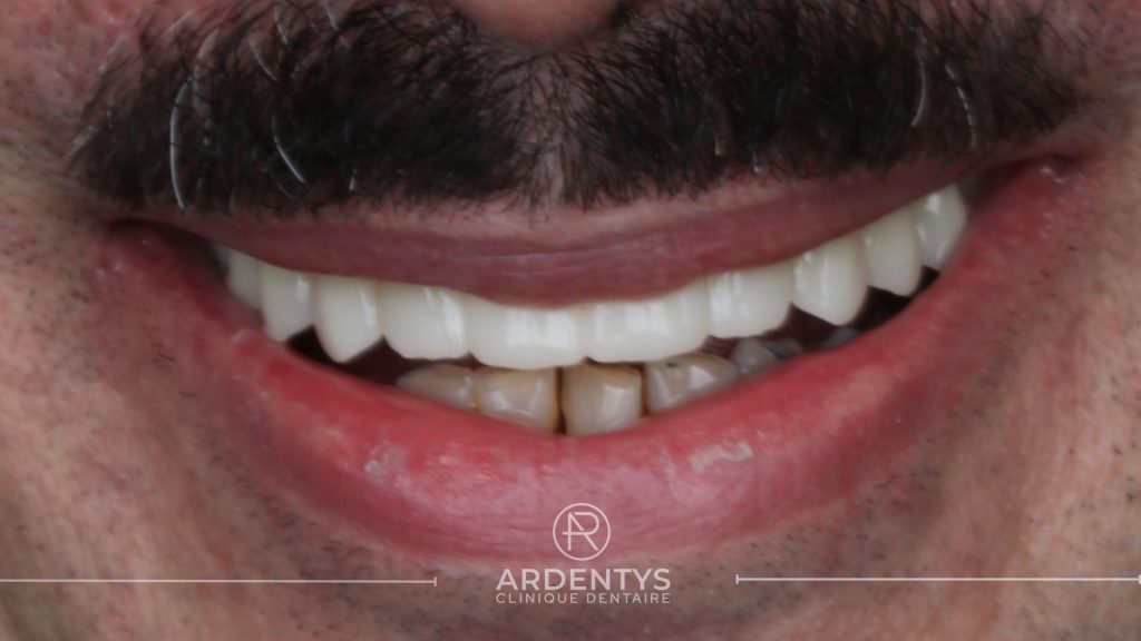 Réhabilitation complète uni maxillaire