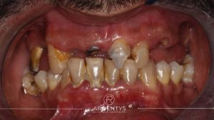 Réhabilitation complète uni maxillaire