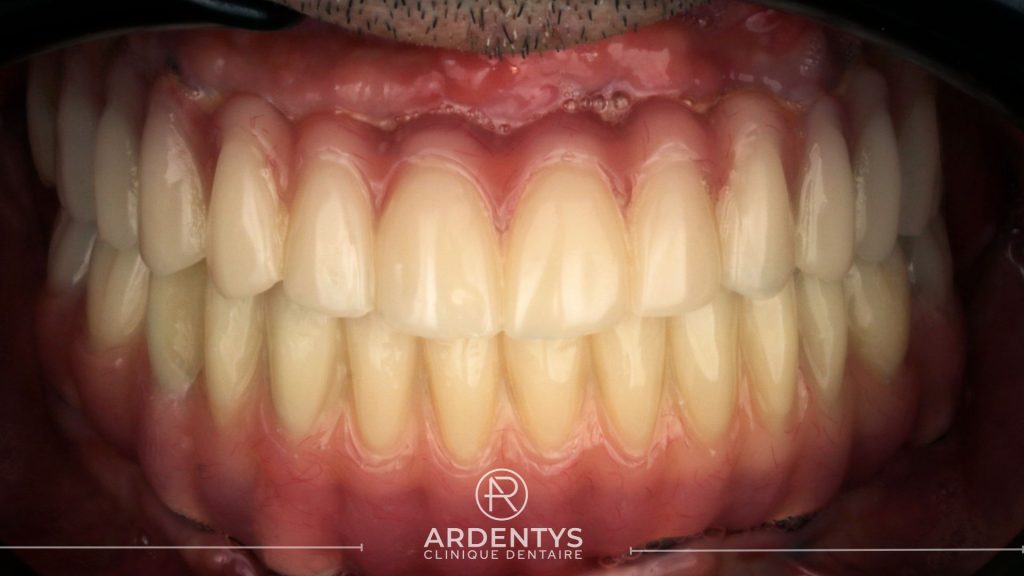 Réhabilitation complète bi maxillaire