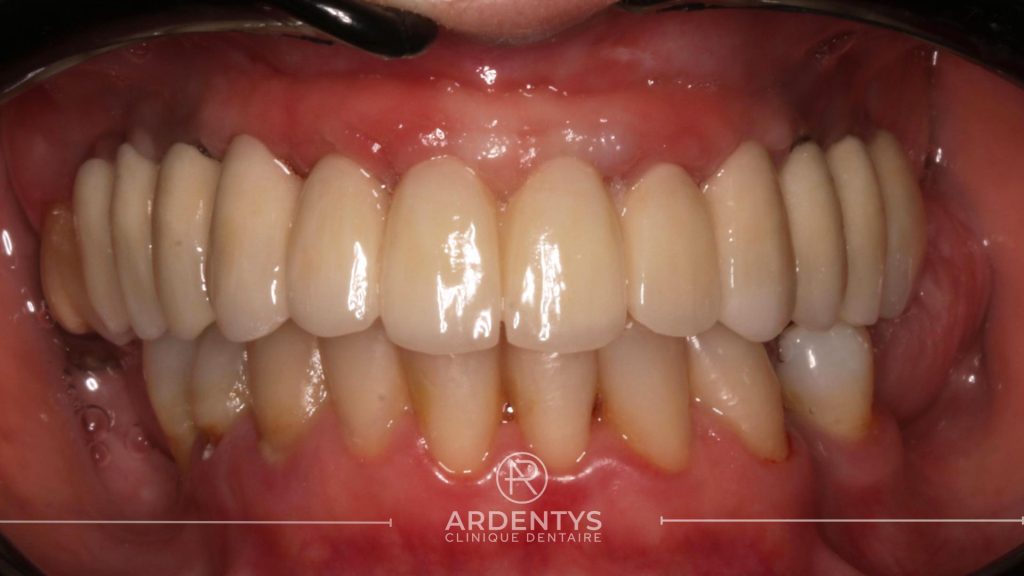 Réhabilitation complète uni maxillaire