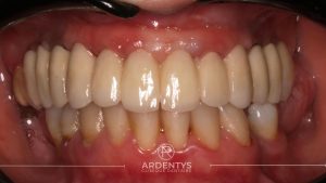 Réhabilitation complète uni maxillaire