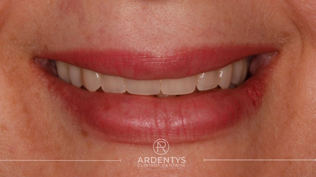 Réhabilitation complète uni maxillaire