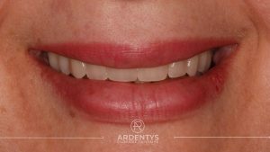 Réhabilitation complète uni maxillaire