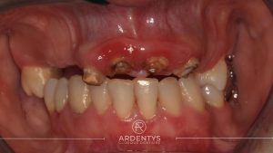 Réhabilitation complète uni maxillaire