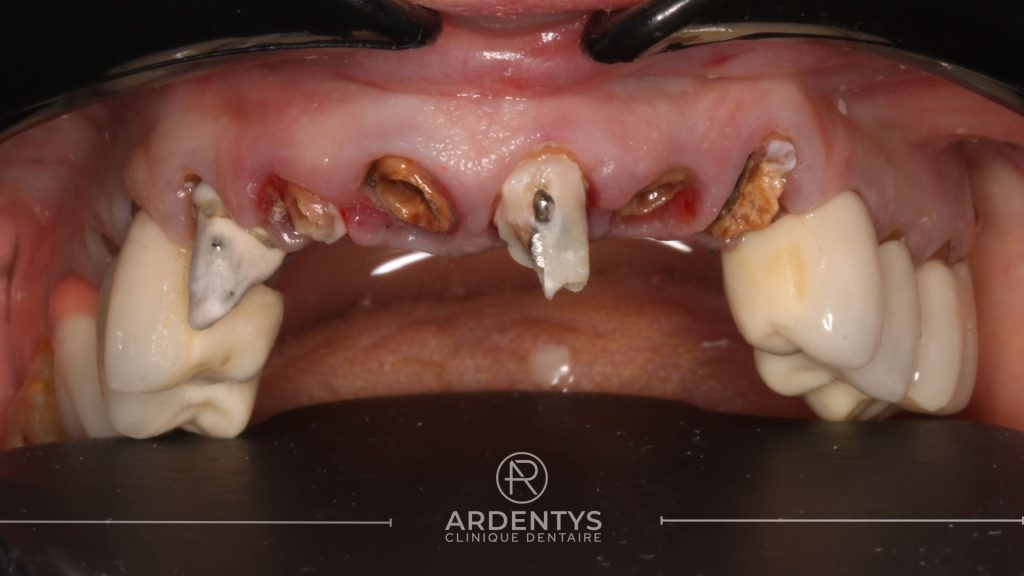 Réhabilitation partielle