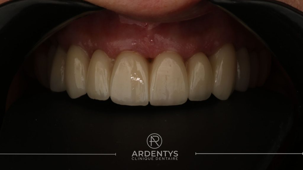 Réhabilitation partielle