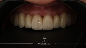 Réhabilitation partielle