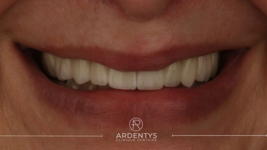 Réhabilitation partielle