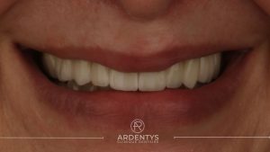 Réhabilitation partielle