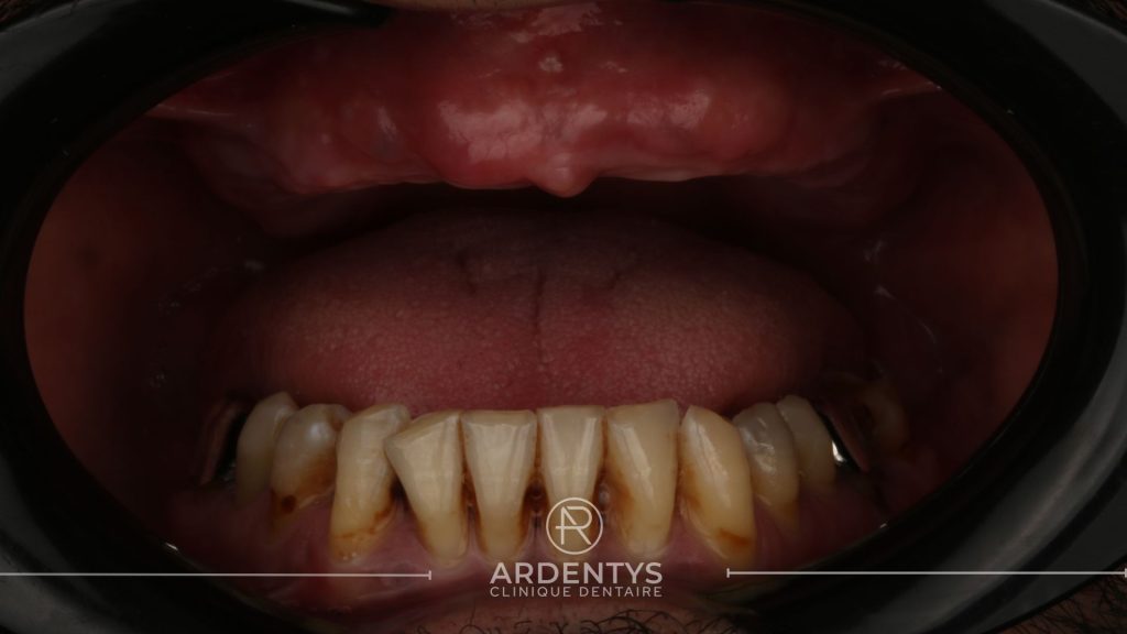 Réhabilitation complète uni maxillaire